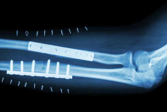 fractur both bone of forearm